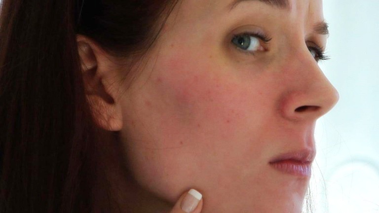 How-to-get-rid-of-redness-on-the-face