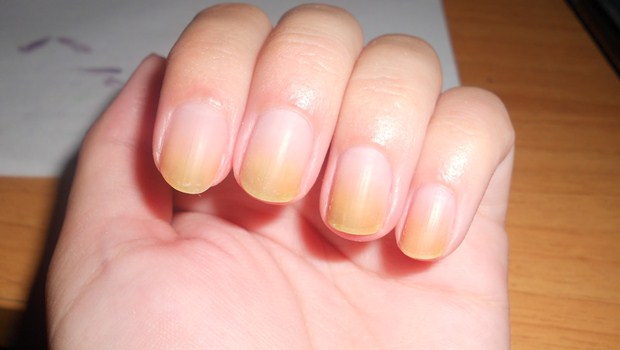 how-to-get-rid-of-yellow-nails-from-nail-polish-–-10-fast-cures