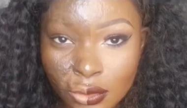 burn-survivor-shalom-blacs-makeup-tutorials-are-inspiring-people-everywhere_1