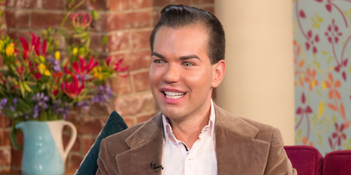 nrm_1416310799-rodrigo-alves-human-ken-hair-transplant-pictures