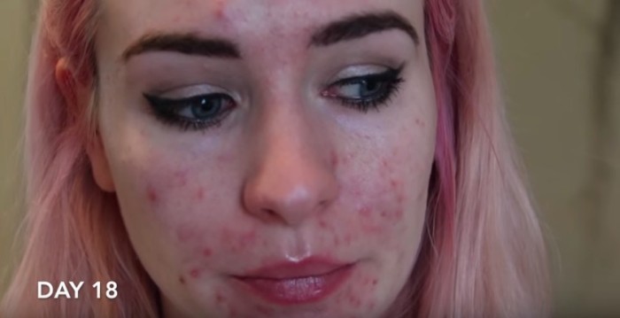 1468187200-blogger-acne