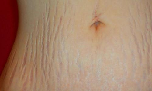 Menghilangkan-selulit-stretch-mark