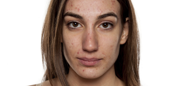 problematic skin