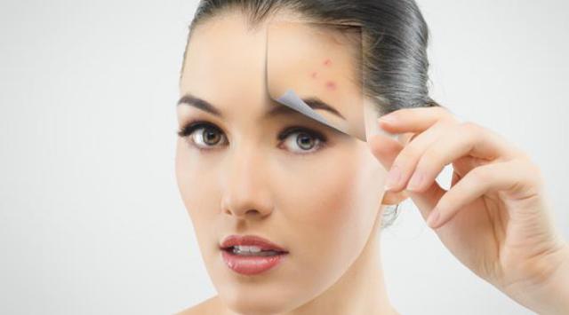 073668800_1417493168-good-acne-treatment-for-oily-skin3