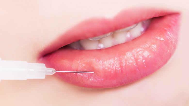 Mengenai Injeksi Bibir